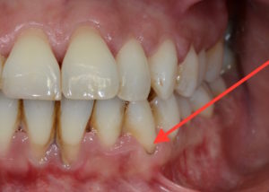 Tartaro nos dentes|Dra. Marcelle Chedid| Dentista Rj