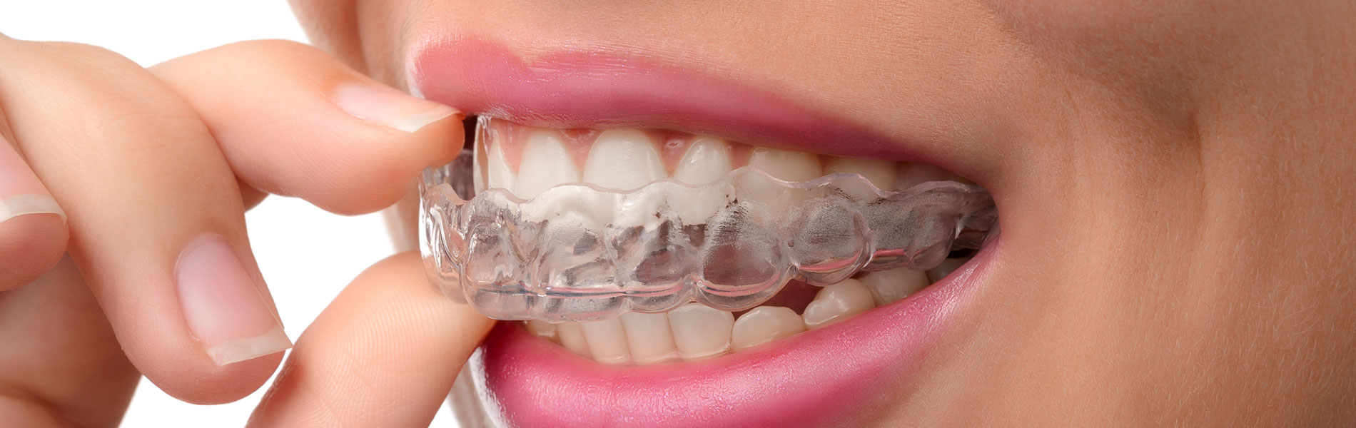 close na boca de uma mulher que veste um aparelho ortodôntico transparente